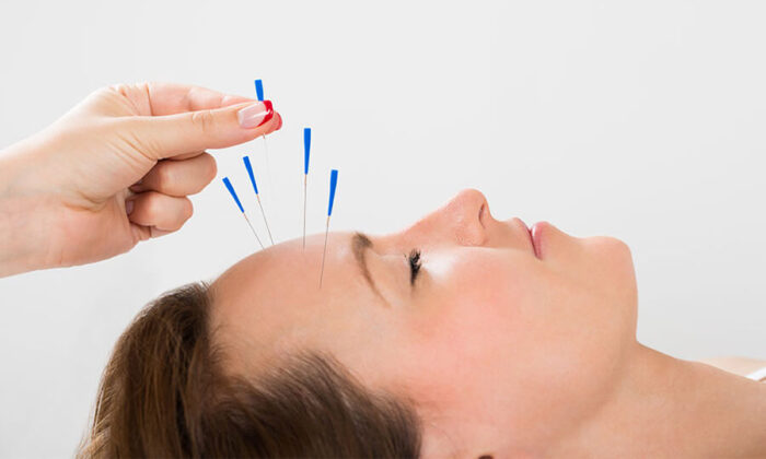 Akupunktur Nedir? Akupunktur İle Zayıflama