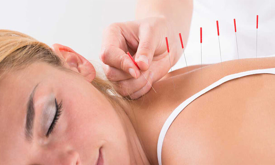 Akupunktur Nedir Akupunktur İle Zayıflama 2