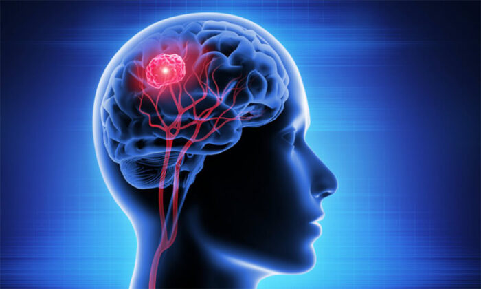 Beyin Kanaması Nedir? Beyin Kanaması Belirtileri ve Tedavi Yöntemleri