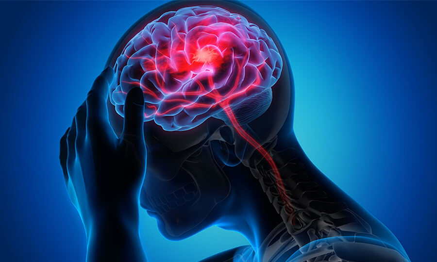 Beyin Kanaması Nedir Beyin Kanaması Belirtileri ve Tedavi Yöntemleri 2