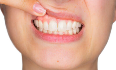 Diş Eti Çekilmesi Nedir? Diş Eti Çekilmesi Tedavisi Nasıl Yapılır?