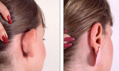 Kepçe Kulak Nedir? Kepçe Kulak Ameliyatı