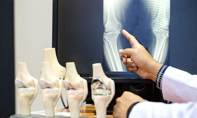 Diz Protezi ve Çeşitleri Nelerdir? Robotik Diz Protezi Ameliyatının Avantajları Nelerdir?