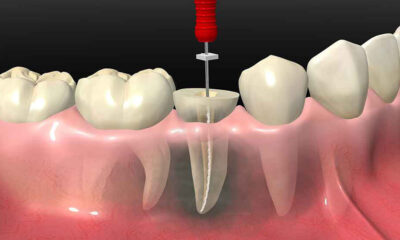 Endodonti Nedir?
