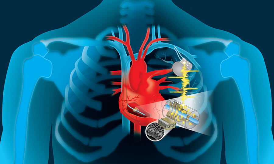 Pacemaker Nedir? Kalp Pili Nasıl Takılır?