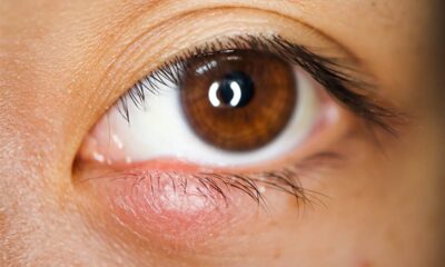 Göz ve Göz Kapağı Tümörleri Nedir?